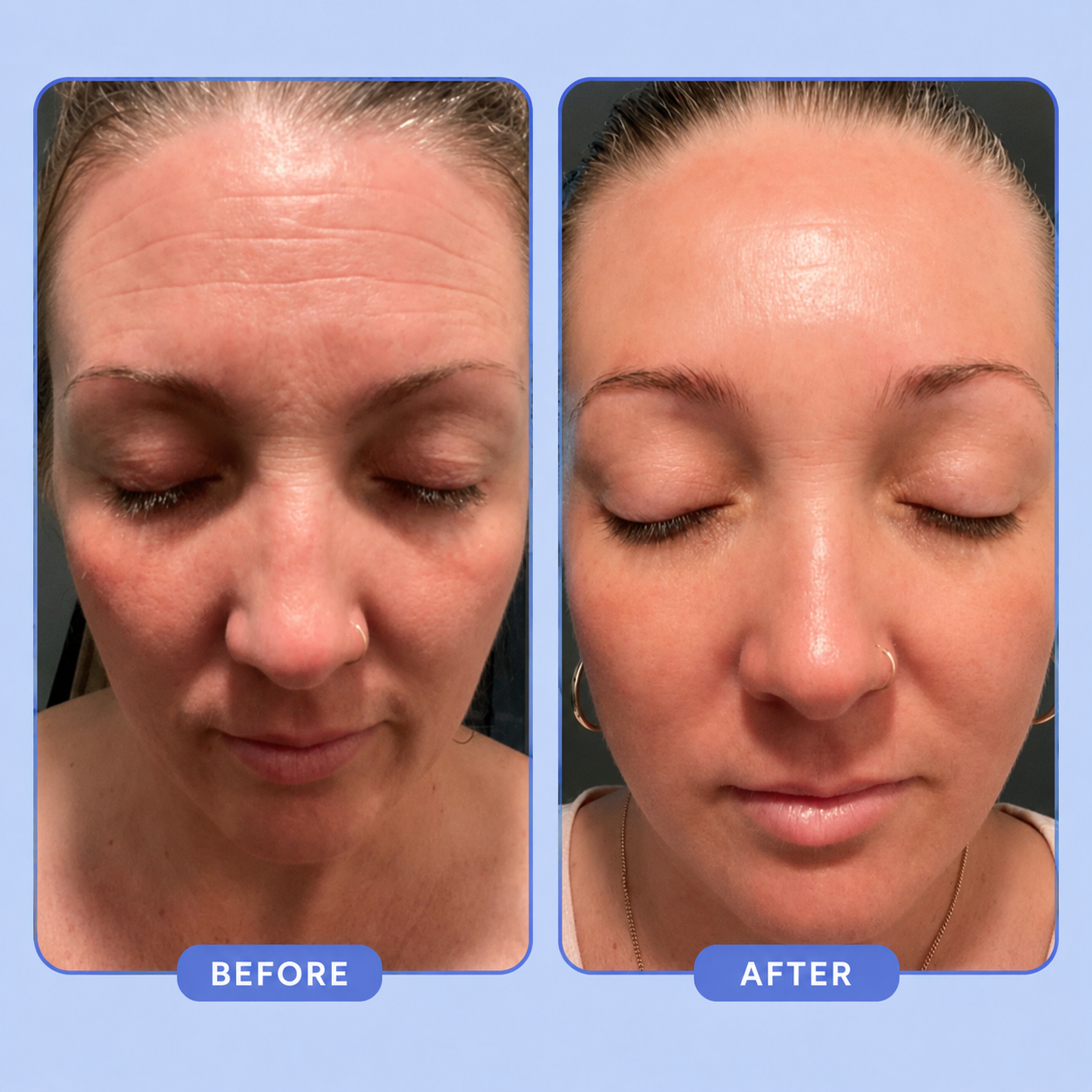 Neleba Sleep Wrinkle Patches